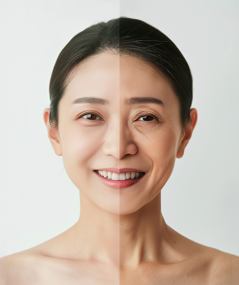 Xóa mờ các dấu hiệu lão hóa: Tiêm filler mặt, tạm biệt nếp nhăn trên trán và khóe mắt.
