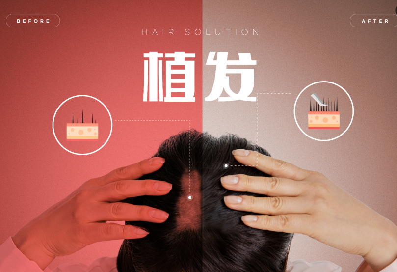 Làm trẻ hóa mái tóc: Bí quyết chăm sóc thiết yếu sau khi cấy tóc và tạo hình đường chân tóc!