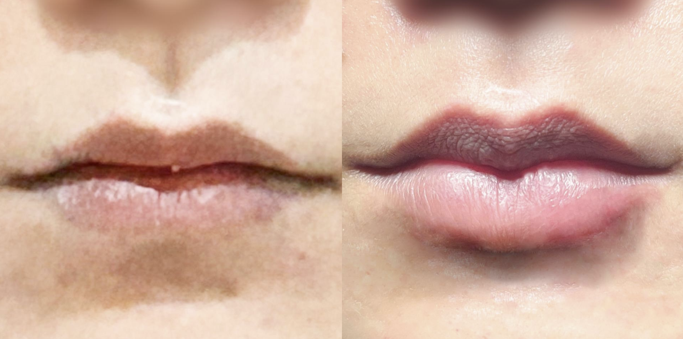 Fotos de antes y después del aumento de labios en la clínica de dermatología Elev en Gangnam, Corea del Sur.